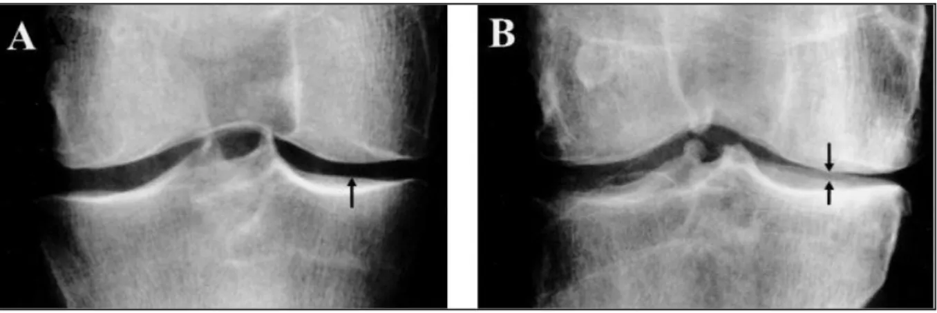 Figure  11:  Importance  de  l’alignement  du  plateau  tibial  et  du  faisceau  de  rayons  X  sur  la  qualité de l’image radiographique 