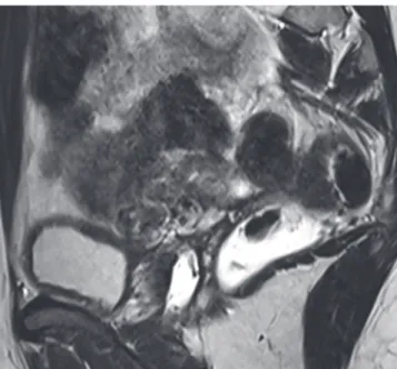 Figure 7 – Coupe IRM sagittale en pondération T2 : artéfacts centro-pelviens dans la région  du colon sigmoïde, en rapport avec le péristaltisme digestif