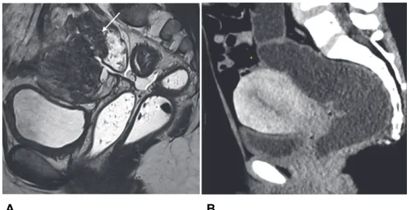 Figure 8 – Coupes IRM en pondération T2 sagittales (A)  et coloscanner en reconstruction  sagittale  (B) : doute sur épaississement de la paroi antérieure du colon sigmoïde en hypo  signal T2 au contact du fond utérin, négativé en coloscanner, en rapport a