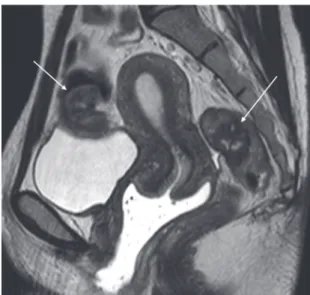 Figure 12 – Coupe IRM T2 sagittale mettant en évidence une double atteinte transmurale  de la paroi digestive au niveau de la charnière recto-sigmoïdienne et plus haut située sur le  sigmoïde