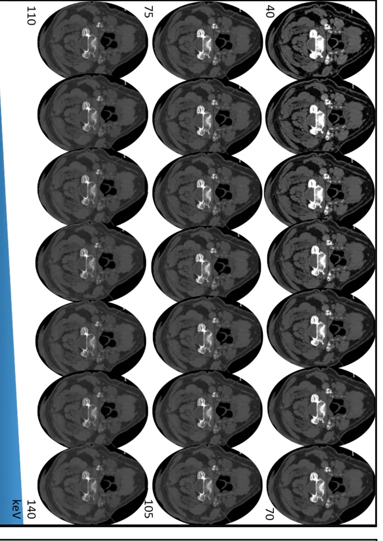 Figure   8   :   Images   mono-­‐énergétiques   virtuelles   reconstruites   de   40   à   140   keV    NB:   les   fenêtres   de   lectures   (niveau   et   largeur)   sont   identiques   pour   ces   21   images