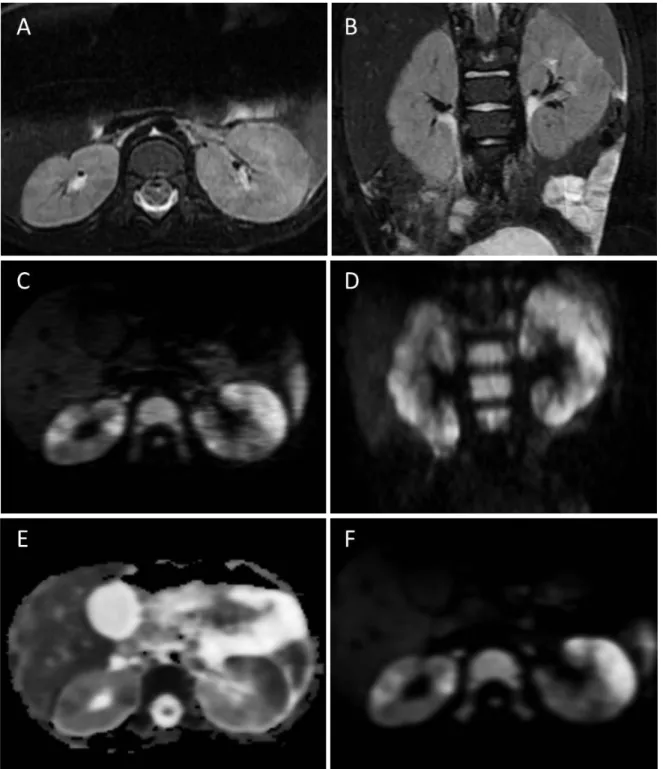 Figure 5 Multiples foyers de néphrites bilatéraux associés à la présence de micro  abcès 