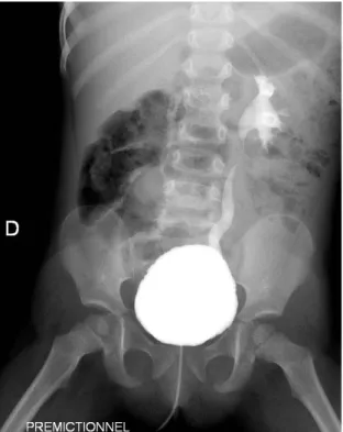 Figure 7 Reflux vésico urétéral gauche de grade III 