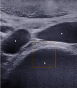 Figure  1:  Marking  Aortic  Iliac  Bifurcation.  a:  aortic  bifurcation;  b:  L4  vertebrae; c: inferior vena cava 