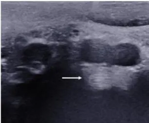 Figure  2:  Example  of  ultrasound  of  L4-L5  annulus  fibrosus.  The  arrow  shows  the  concentric parallel lamellae