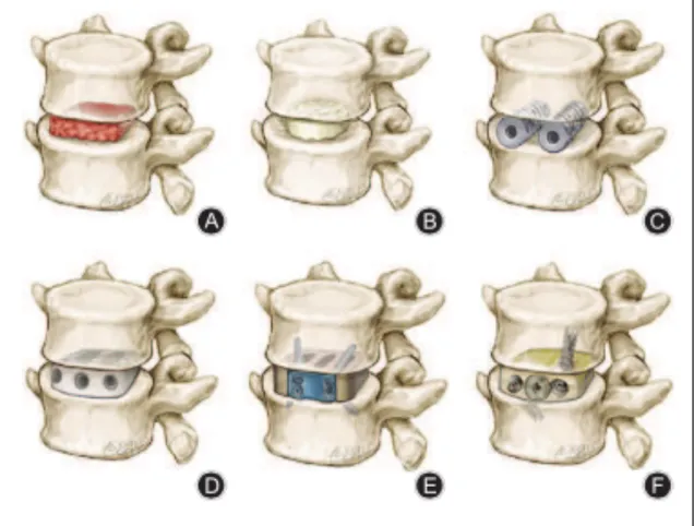 Figure 16. Evolution des arthrodèses intersomatiques par voie antérieure : (A) greffon  tricortical, (B) allogreffe fémorale, (C) cage BAK, (D) cage en PEEK, (E) implant  SynFix® DEPUY SYNTHES, (F) cage Ti-PEEK Magnum+® BUSINESS WIRE