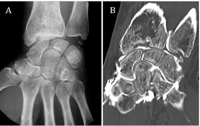 Figure 7 : Arthrose radio-carpienne secondaire à un cal vicieux articulaire post-traumatique sur la  radiographie (A) et l’arthro-scanner (B)