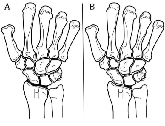 Figure 8 : Arthrodèses radio-carpiennes partielles : radio-scapho-lunaire (A) et radio-lunaire (B)