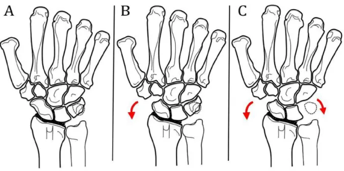 Figure 9 : Arthrodèse radio-scapho-lunaire seule (A), avec excision du pôle distal du scaphoide (B)  et  triquétrectomie  (C)