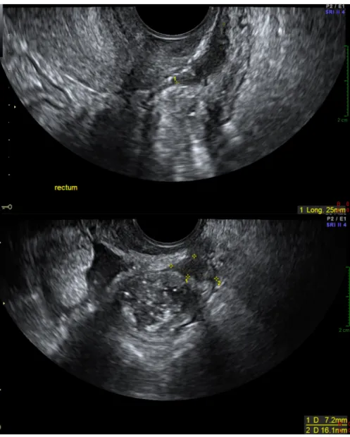 Figure  3 :  Coupes  sagittale  (en  haut)  et  axiale  (en  bas)  en  échographie  endo-vaginale  après  lavement  du  rectum:  endométriose  pelvienne  profonde  infiltrant  la  paroi  antérieure  du  rectum  (calipers)