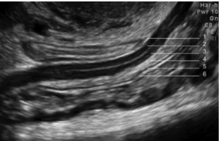 Figure  4 :  Coupe  sagittale  en  échographie  endo-vaginale  d’un  rectum  normal  après  préparation  digestive,  montrant  (de  dehors  en  dedans) :  la  séreuse  (1)  en  fin  liseré  hyperéchogène, la musculeuse en deux bandes hypoéchogènes externe 