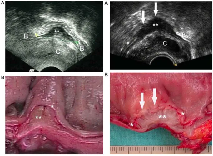 Figure 6 : Endométriose pelvienne profonde rectale en échographie endo-vaginale sans  préparation  ni  opacification  rectale  (protocole  proposé  par  Hudelist  et  al.),  avec  correspondance macroscopique