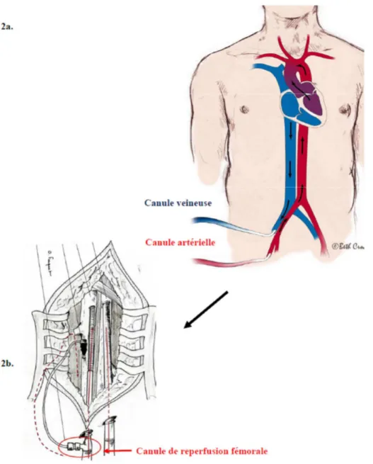 Figure 2 : 2a. ECMO périphérique: 1 canule veineuse de drainage dans la veine fémorale, 1 canule de  réinjection rétrograde dans l'artère fémorale