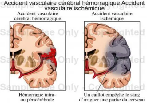 Figure n° 1: schéma de physiopathologie de l’AVC hémorragique versus ischémique 