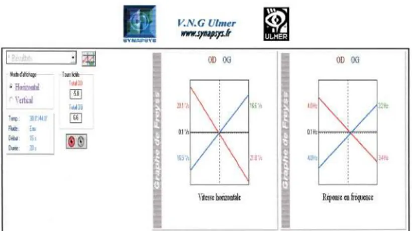 Figure 2.4 – VNG à au quatrième jour d’évolution = normale.