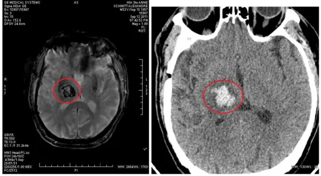 Figure 2.6 – IRM cérébrale, coupe axiale, séquence T2* et scanner cérébral, coupe axiale : Hématome thalamique droit de 25 mm de diamètre.