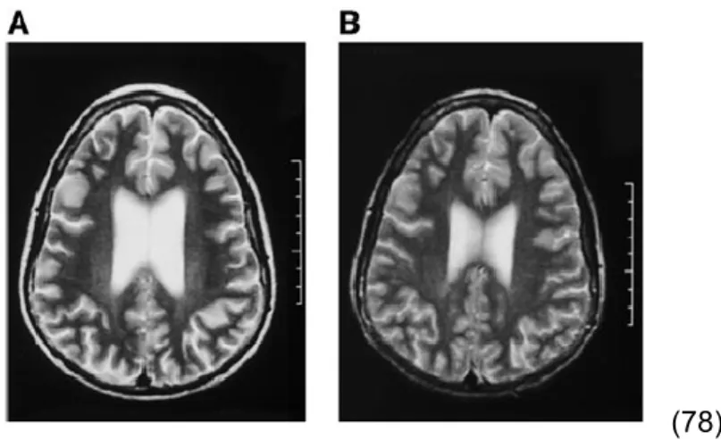 Tableau  3  :  Volume  des  différentes  structures  cérébrales  chez  des  enfants  atteints  de  la  maladie  de  Cushing  avant  le traitement  (baseline),  1  an  après la rémission  chirurgicale,  et  des témoins sains appariés sur le sexe et l’âge (7