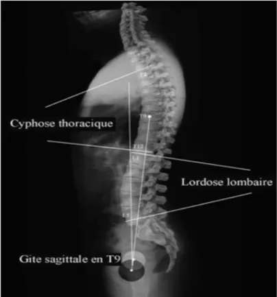 Figure 3 Mesures des angles de cyphose dorsale et lordose lombaire 
