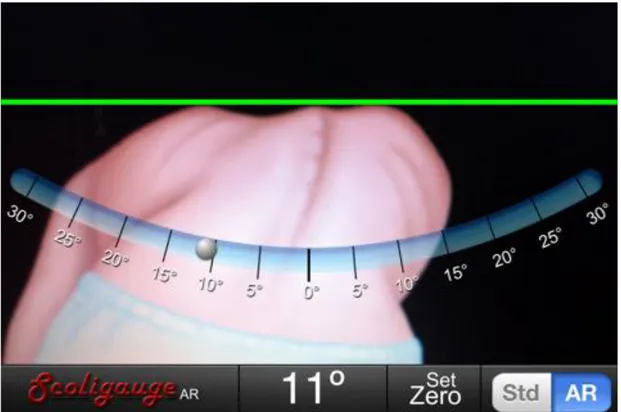 Figure 2. Capture d'écran de l'application Scoligauge, iOS®. 