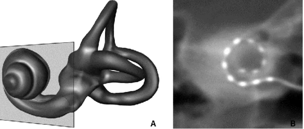 FIG. 1. Coronal oblique reconstruction: « CBCT Cochlear view ». A, Three-dimensional (3D) representation of a  left labyrinth demonstrating coronal oblique plane of section