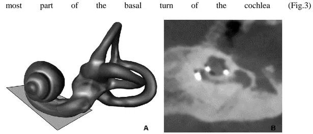 FIG. 3.Axial oblique reconstruction.A, 3D representation of a left labyrinth demonstrating axial oblique plane of  section.B, 2D reconstruction from CBCT