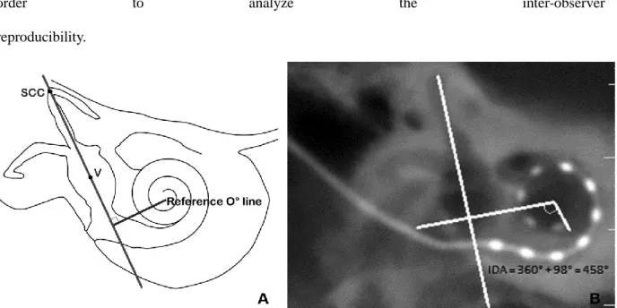 FIG. 5. Measurements of the insertion depth angle (IDA). A, Schematic 2D representation of a right cochlea and  vestibule
