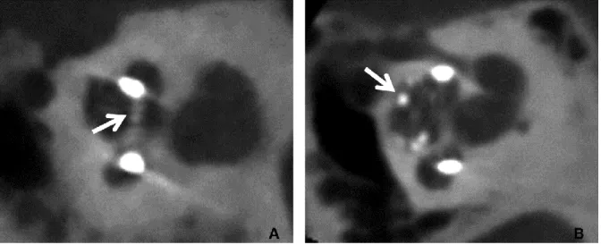 FIG. 6.Dislocation of the electrode array on a sagittal oblique reconstruction. A, Using a precurved perimodiolar  electrode from Cochlear © 