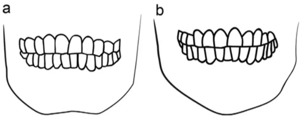 Figure 4. Différence entre le menton osseux masculin (a) et féminin (b) (3) 
