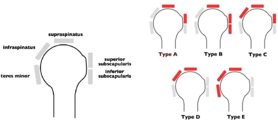 Figure 2 : Types de ruptures massives de coiffes selon P.Collin et al. : le type D correspond à la rupture postéro-supérieure 