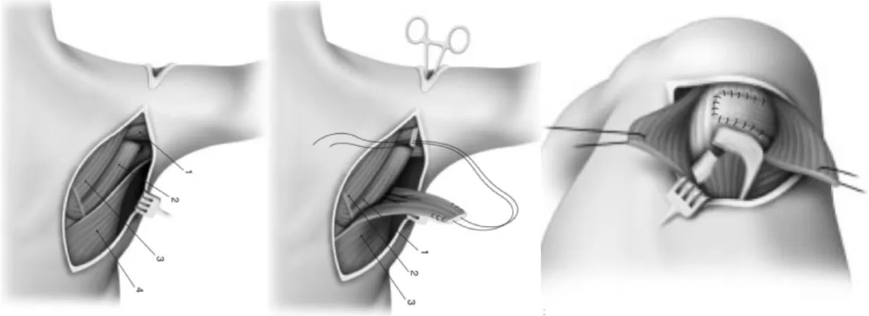 Figure 20 : Lambeau deltoïdien : Incision centrée sur épaule expose la coiffe et une incision dorsale de 20 cm pour prélever le grand  dorsal