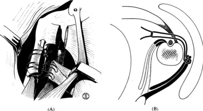 Figure    6    :    Schéma    de    R.    Merle    d'Aubigné    (1949)    représentant    comment    les    tendons    du        Latissimus   dorsi   et   du   Teres   major   sont   suturés,   passés   autour   de   la   diaphyse   humérale   et    fixés 