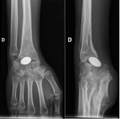 Figure 15 : Radiographies post opératoires tardives, malposition de l’implant avec un grand axe  antéro postérieur 