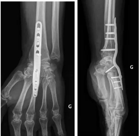 Figure 16 : Arthrodèse totale de poignet, reprise après échec d’Amandys®.     