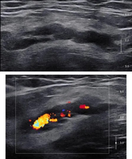 Figure 4: Echographie – Doppler d’une MVe symptomatique des tissus mous profonds développée  sur le versant profond du muscle petit fessier gauche chez un jeune homme de 21 ans : l’examen 