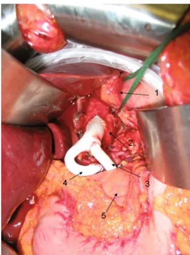 Figure   10   :   Pontage   antérograde   aorto-­‐mésentérique   supérieur   et   hépatique
