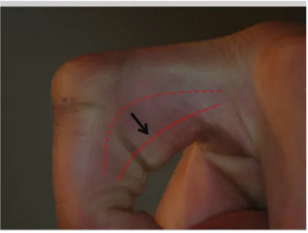 Fig. 4 : Effet « corde d’arc » des tendons fléchisseurs suite à une rupture de poulie A2