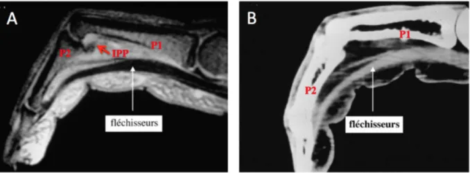 Fig. 5: Mise en évidence du décollement de l’appareil fléchisseur du plan osseux en position arquée sur IRM (A)  et sur scanner (B) qui confirme la rupture de poulie