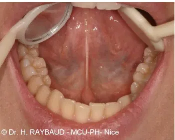 Figure n°16 : plancher buccal antérieur  