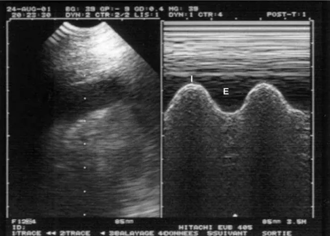 Figure 7 - Échographie d'un épanchement liquidien pleural   Image de gauche : mode B, image de droite : mode TM 
