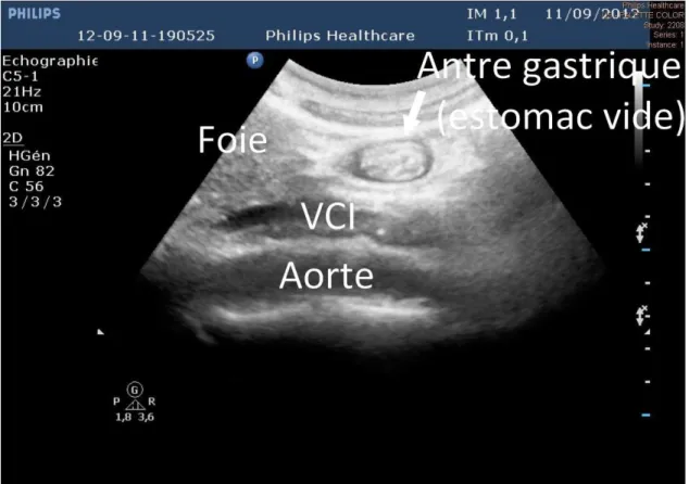 Figure 14 - Vue échographique d'un antre gastrique correspondant à un estomac vide                           VCI : Veine Cave Inférieure 