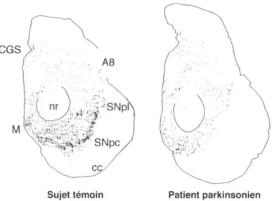 Figure  2 :  Sections  du  mésencéphale  montrant  une  dégénérescence  des  neurones  dopaminergiques  de  la  substantia  nigra  pars  compacta  (SNpc)  chez  un  patient  parkinsonien  (droite) en comparaison à un sujet normal (gauche) (6)