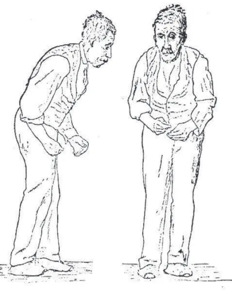 Figure 4 : Dessin Parkinson disease par Sir William Richard Gowers - 1886 