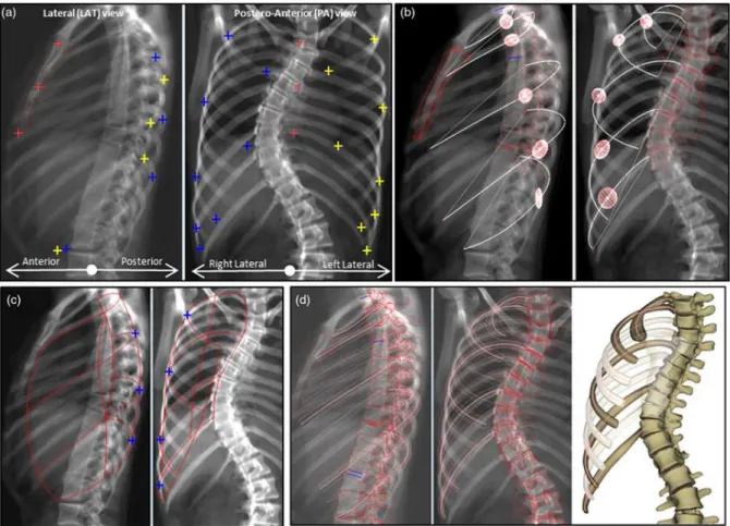 Figure 6: From identifications to first estimate: a) Anatomical landmarks digitalized on  both radiographs (left and right side was plotted in yellow and blue) : tip of ribs R2-R5-R8 in  frontal views and tip of R10 in both views; most lateral point in PA 