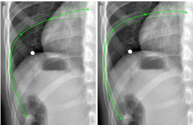 Figure 7: Rib cage global parameters: a) maximum antero-posterior and lateral  diameters and maximal rib hump angle computed in transversal planes; b) volume of  rib cage; c) transversal (left) and lateral (right) views of volumetric spinal penetration 