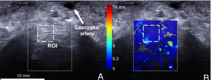 Figure 4 - Characteristic transversal image of intervertebral disc (sample #1), in ultrasonography (A) and  elastography (B)