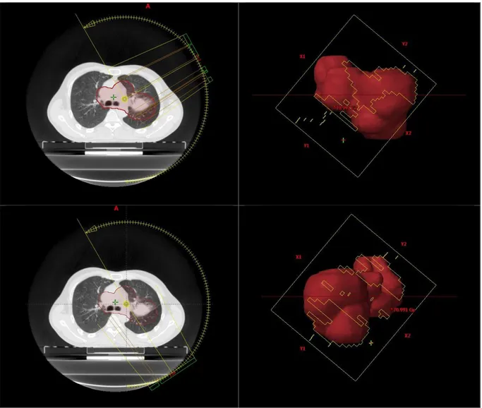 Figure  6 :  Exemple  de  balistique  IMRT  pour  une  tumeur  latéralisée  à  gauche