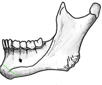 Figure 5 : traits d’ostéotomie (génioplastie) vue latérale mandibulaire 