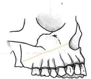 Figure 8 : traits d’ostéotomie (Le Fort I) vue latérale maxillaire 