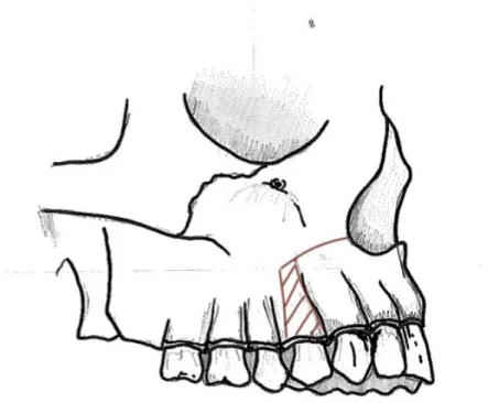 Figure 11 : traits d’ostéotomie (Wassmund) vue latérale maxillaire 