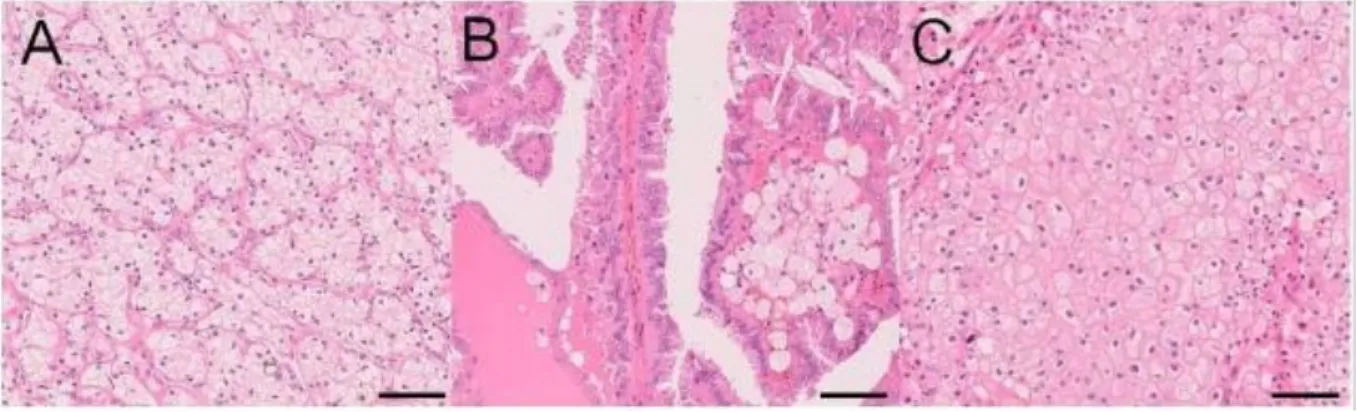 Figure 3 : Morphologie des trois principaux types de carcinomes rénaux. A. Carcinome à  cellules claires B